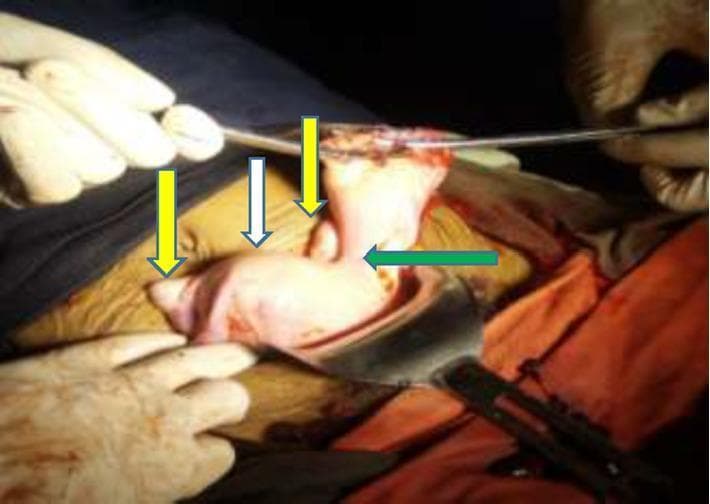 This clinical photograph shows an intraoperative view of a female reproductive system following the resection of a ruptured ectopic pregnancy. The image illustrates a congenital Mullerian duct anomaly, specifically a unicornuate uterus with a non-communicating rudimentary horn. A white arrow identifies the main unicornuate uterine body, while a green arrow points to the left-sided rudimentary horn. The connection between the two structures is visible as a bridge of dense fibro-muscular tissue. Yellow arrows indicate the bilateral ovaries, which appear in their relative anatomical positions. The tissues are fleshy and vascularized, consistent with a surgical environment. This case demonstrates the anatomical relationships associated with Class II Mullerian anomalies according to the American Society for Reproductive Medicine (ASRM) classification, highlighting the risk of obstetric complications such as rudimentary horn pregnancy and rupture.