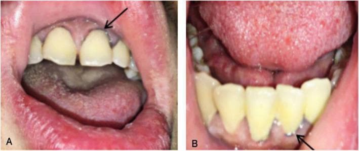 Two intraoral clinical photographs (A and B) demonstrate a characteristic physical finding of Chronic Lead Poisoning (CLP). Image A shows the maxillary gingiva where a black arrow points to a 'Burton line'—a distinct, thin, blue-grey or dark line occurring along the gingival margin at the base of the teeth. Image B displays the mandibular gingiva with a similar dark line indicated by an arrow. The surrounding oral tissues exhibit signs of poor dental hygiene, including yellowish dental discoloration, mild gingival inflammation, and a coated tongue. Burton lines are a classic clinical sign of lead toxicity, resulting from the reaction of circulating lead with sulfur-producing bacteria in the oral cavity, forming lead sulfide precipitates in the gum tissue. This visual evidence serves as a critical diagnostic clue for heavy metal exposure in patients presenting with systemic symptoms such as abdominal pain or anemia.