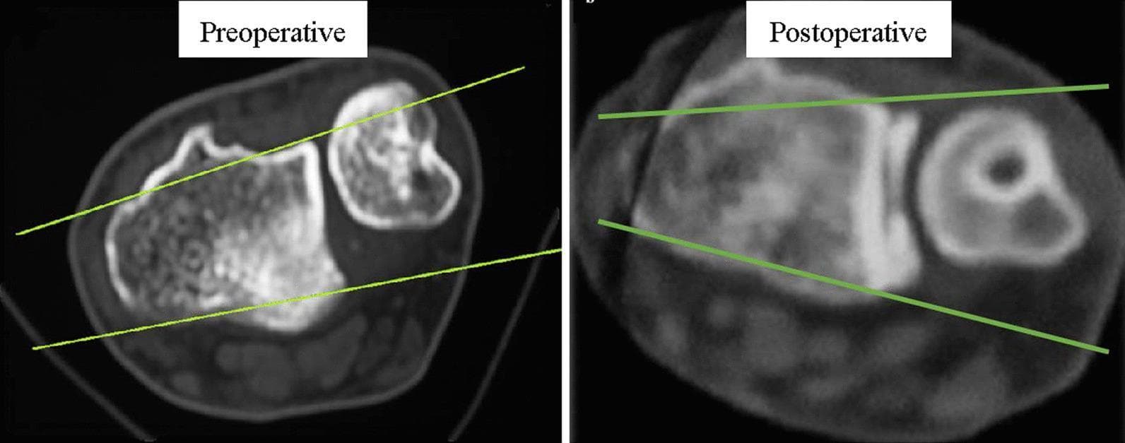 This diagnostic comparison contains two cross-sectional axial CT scans of the wrist, demonstrating the distal radioulnar joint (DRUJ) in neutral position. Both images utilize Mino's criteria, with two parallel reference lines drawn along the dorsal and palmar cortical borders of the distal radius to assess ulnar alignment. The 'Preoperative' image shows the ulnar head displaced dorsally, lying outside the space defined by the tracing lines, which indicates dorsal subluxation of the DRUJ. The 'Postoperative' image displays the ulnar head successfully reduced and centered between the two reference lines, signifying restored joint congruency following surgical reconstruction. These images serve as an educational tool for evaluating TFCC injury-related instability and the efficacy of anatomic radioulnar ligament reconstruction. Key anatomical features visible include the distal radius sigmoid notch, the ulnar head, and internal bony trabecular patterns.