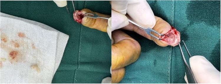 This composite clinical photograph displays an intraoperative view of a surgical procedure on the distal phalanx of a human finger. The image depicts the excision and curettage of an intraosseous epidermoid cyst. A 'fish mouth' flap incision is visible at the fingertip, revealing a window opened through the thinned phalangeal cortex. Surgical instruments, including forceps and a small retractor, are used to expose the cystic cavity within the bone. The content of the cyst, which has been removed and placed on a surgical gauze for inspection, is characterized by a creamy, yellowish-white, and clumpy texture consistent with keratinized material. There is evidence of mild surrounding inflammation and surgical bleeding. This visual demonstrates the classic surgical findings of an intraosseous epidermoid cyst, highlighting the cortical thinning and the pathognomonic sebaceous-like or keratinous material found within the lytic bone lesion. It serves as an educational resource for orthopedic surgery and pathology, illustrating the clinical presentation of rare bone cysts in the hand.