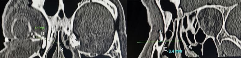 This diagnostic image consists of two parasagittal computed tomographic dacryocystography (CT-DCG) views of the lacrimal drainage system and nasal cavity. The imaging demonstrates the spatial anatomy of a small lacrimal sac relative to key surgical landmarks used in endoscopic dacryocystorhinostomy (DCR). In the left panel, the common canaliculus (CC) is identified, with a horizontal reference line (B) drawn at a right angle to the sac's long axis; measurement 'D' indicates the height of the sac fundus above the CC (1.1 mm). The right panel focuses on the middle turbinate axilla (MTA), with a reference line (A) drawn perpendicular to the sac; measurement 'C' shows the height of the sac fundus above the MTA (8.4 mm). Visible structures include the contrast-filled lacrimal sac, the maxillary frontal process, ethmoid air cells, and the middle turbinate. This imaging approach provides precise preoperative localization of the lacrimal sac and fundus in relation to intranasal landmarks, essential for planning surgical osteotomy and mucosal incisions.