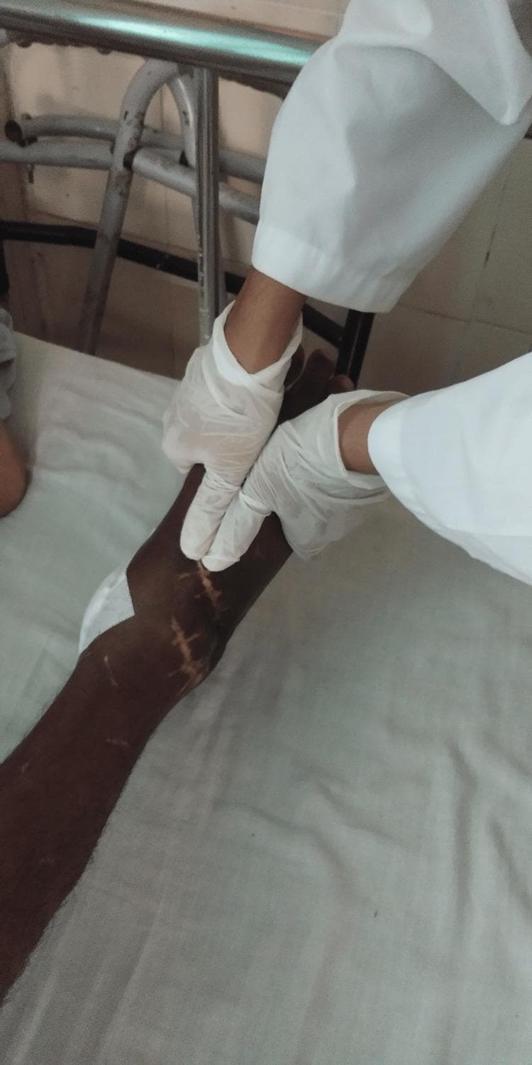 This clinical procedural photograph demonstrates a physical therapist performing Maitland mobilization glides on a patient's right ankle joint. The patient is in a supine position, showing a dark-skinned lower limb with multiple prominent, well-healed surgical scars extending proximally from the anterior and lateral aspects of the ankle, consistent with prior orthopedic intervention for a talus fracture. A white dressing is partially visible near the posterior ankle. The therapist, wearing a white medical gown and sterile white gloves, is shown applying manual force with both hands positioned over the talocrural joint to facilitate joint mobilization. The educational focus of the image is on manual therapy techniques used to increase range of motion and reduce pain in patients with post-traumatic ankle arthritis and equinus deformity. The setting appears to be a clinical rehabilitation or orthopedic ward.