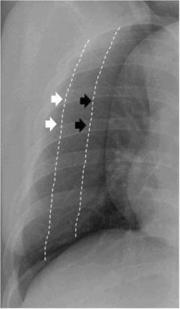 This chest radiograph (X-ray) demonstrates the semiquantification of pleural effusion size within the thoracic cavity. The image depicts a lateral or oblique perspective of the hemithorax, highlighting pleural fluid accumulation and its radiographic density. Two distinct areas are annotated with dotted lines and arrows to differentiate effusion severity. White arrows point to a thinner, less opaque lateral region outlined by a white dotted line, representing a 'small' pleural effusion (occupying less than one-third of the hemithorax). Black arrows point further medially to a broader area of increased radiographic density outlined by a second dotted line, representing a 'moderate' pleural effusion (occupying between one-third and two-thirds of the hemithorax). The visual comparison illustrates how the depth and volume of fluid increase opacity and alter the visible lung field. This pedagogical tool is used in pulmonology and radiology to teach standardized visual estimation of pleural fluid volume based on thoracic occupation ratios.