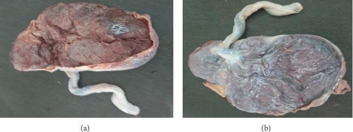 Two gross clinical photographs displaying the maternal and fetal surfaces of a human placenta, specifically illustrating morphological changes associated with pregnancy-induced hypertension (PIH). Panel (a) shows the maternal surface, which exhibits a reddish-brown, mottled texture with cotyledons. Areas of darker discoloration and a notable grayish-white patch are visible, potentially indicating infarction or calcification. The umbilical cord is shown with an eccentric insertion. Panel (b) depicts the fetal surface, characterized by a smooth, translucent amnion with a distinct bluish-purple hue. Branching chorionic vessels are visible radiating from the site of umbilical cord insertion, which is more centrally located compared to panel (a). The umbilical cords in both specimens appear thick, whitish, and demonstrate typical helical coiling. These images serve as educational examples of gross placental pathology, highlighting how systemic maternal conditions like hypertension can manifest in placental morphology and cord insertion patterns.