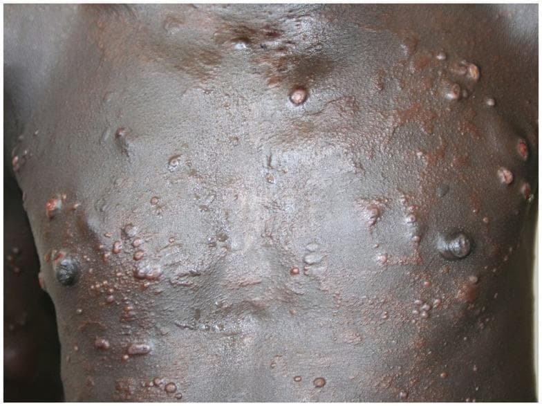 This clinical photograph displays a widespread cutaneous eruption on the anterior trunk of a patient with darkly pigmented skin. The lesions consist of numerous firm, well-demarcated, dome-shaped papules and nodules that vary in size from 2 mm to over 1 cm. Many lesions exhibit a smooth, glistening, succulent surface characteristic of histoid leprosy, a variant of multibacillary leprosy. The distribution is symmetric across the chest and abdomen, with a tendency toward clustering. Colors of the lesions range from flesh-colored to reddish-brown or copper tones. While most nodules are intact without scaling or ulceration, the background skin shows focal areas of thickening and subtle textural changes. This image serves as a classic diagnostic example of the cutaneous manifestations of histoid leprosy (Mycobacterium leprae), often seen in patients following inadequate treatment or developing de novo resistance.