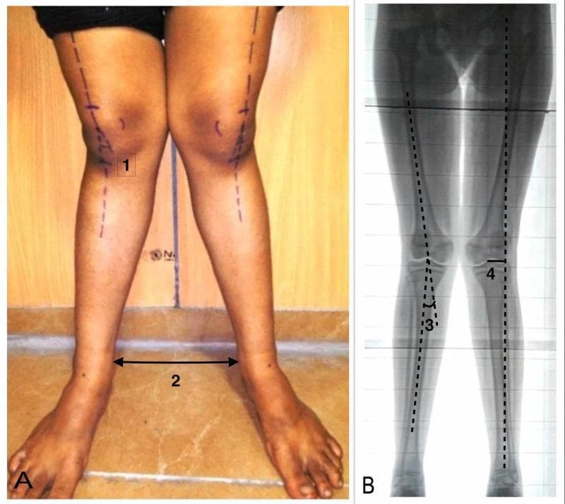 This dual-panel image demonstrates the preoperative assessment of a lower limb deformity, specifically genu valgum (knock-knees).
Panel A is a clinical photograph of a patient standing in an anterior view. It displays surface anatomy and clinical measurements. Marked on the skin are the anatomical axes of the femurs and tibiae. Label (1) indicates the clinical tibiofemoral angle, while label (2) highlights the intermalleolar distance (IMD), measured between the medial malleoli while the knees are touching.
Panel B is a corresponding standing anteroposterior (AP) long-limb X-ray scanogram showing the skeletal structure from the hips to the ankles. This radiographic view allows for precise angular measurements. Label (3) indicates the radiological tibiofemoral angle, formed by the intersection of the femoral and tibial anatomical axes. Label (4) denotes the mechanical axis deviation (MAD), which is the distance between the center of the knee joint and the mechanical axis line (drawn from the center of the femoral head to the center of the ankle). This comparison illustrates the correlation between physical examination findings and radiographic evidence in orthopedic surgical planning.