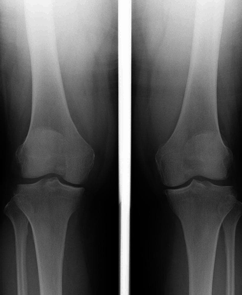 Anteroposterior (AP) weight-bearing X-ray of bilateral knee joints demonstrating degenerative changes associated with osteoarthritis. The imaging shows a bilateral varus alignment, with a measured femorotibial angle (FTA) of 175 degrees in the right knee. Characteristic features of Grade II Kellgren-Lawrence classification are present, including narrowing of the medial compartment joint spaces, marginal osteophyte formation at the femoral and tibial condyles, and mild subchondral sclerosis. These findings are most pronounced in the right knee. The patellofemoral and lateral compartments appear relatively preserved. The visualization of the proximal tibia and distal femur supports an orthopedic evaluation of mechanical axis deviation and joint degeneration. This diagnostic image is intended for clinicians and medical students studying degenerative joint disease and surgical planning for corrective procedures.