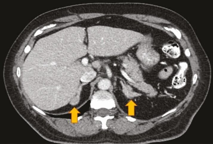 This diagnostic image is an axial (cross-sectional) computed tomography (CT) scan of the upper abdomen at the level of the adrenal glands. Key anatomical structures visible include the liver in the right upper quadrant, the spleen in the left upper quadrant, the vertebral column and paraspinal musculature posteriorly, and portions of the stomach and bowel loops. Two yellow arrows highlight the primary pathology: bilateral adrenal nodular hyperplasia. The adrenal glands appear significantly enlarged and demonstrate a nodular, irregular morphology rather than the typical 'Y' or 'V' shape. This finding is characteristic of chronic overstimulation of the adrenal cortex, as seen in patients with congenital adrenal hyperplasia (CAH). The image provides clinical evidence of the structural changes occurring in the adrenal glands due to enzymatic deficiencies in the steroidogenesis pathway. The scan also demonstrates clear visualization of the retroperitoneal fat planes, which assist in identifying the demarcated adrenal nodules against surrounding tissues.
