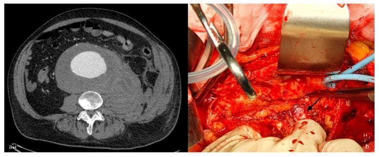This dual-panel image provides a comparison between diagnostic imaging and intraoperative findings of a ruptured abdominal aortic aneurysm (RAAA). Panel (a) is an axial Computed Tomography Angiography (CTA) scan of the abdomen demonstrating a large abdominal aortic aneurysm (AAA) with a significant eccentric mural thrombus and a bright contrast-enhanced lumen. A large, ill-defined, hyperdense area is visible in the left retroperitoneum, characteristic of a postero-lateral rupture with an associated retroperitoneal hematoma. Panel (b) is a clinical photograph of the subsequent open surgical repair. The surgical field shows extensive dissection and hemorrhage consistent with acute rupture. A metallic retractor (Deaver or similar) provides exposure, and a black arrow indicates the exposed anterior surface of a lumbar vertebral body, a finding that occurs when the posterior wall of the aorta is breached and the hematoma dissects pre-vertebral tissues. Surgical instruments, suction tubing, and vessel loops are visible within the operative field, highlighting the complexity of emergency vascular reconstruction and hemorrhage control in RAAA cases.