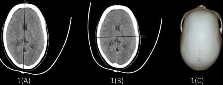 This composite educational image demonstrates the morphological characteristics of a dolichocephalic skull using radiological and anatomical modalities. Panels 1A and 1B show non-contrast axial computed tomography (CT) scans of the head at the level of the lateral ventricles. Panel 1A highlights the maximum cranial length (18.64 cm) along the anteroposterior axis, while Panel 1B shows the maximum cranial breadth (13.21 cm) along the transverse axis. The brain parenchyma and ventricular systems appear normal, with the hyperdense (white) calvarium outlining the elongated cranial vault. Panel 1C provides a superior-view clinical photograph of a dry skull specimen, clearly illustrating a cephalic index of 70.86, characteristic of dolichocephaly (long-headedness). Key anatomical landmarks visible in 1C include the sagittal suture and the overall narrow, elongated contour of the cranium. These visuals serve as a reference for cephalometry and anthropometric classification in forensic medicine, radiology, and neurosurgery.