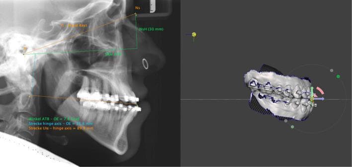 This composite image illustrates the integration of 2D cephalometric radiography with 3D digital dental modeling for orthodontic and orthognathic surgery planning. The left panel shows a lateral cephalometric X-ray with overlayed cephalometric analysis. Key reference points include the Nasal Rest (Ns), Axis Orbital Plane (AOP), and the articulator’s hinge axis. Quantitative measurements are displayed: an angle of 7.8 degrees between the upper occlusal plane (OE) and AOP, a 35.8mm vertical distance from the hinge axis to the OE, and an 89.9mm horizontal distance from the hinge axis projection to the upper incisor edge. The right panel displays a corresponding 3D intraoral scan of the dentition featuring active orthodontic appliances (brackets and wires). The model is oriented within a virtual world frame, featuring a transformation widget at the incisal edge for adjusting pitch, roll, and yaw. A red rotational arrow indicates planned movement. This combined approach facilitates virtual mounting and precise simulation of maxillofacial jaw repositioning.