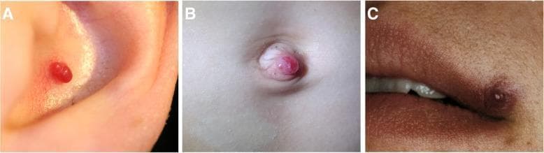 This composite clinical photograph displays three distinct presentations of pyogenic granuloma (lobular capillary hemangioma) in different anatomical locations. (A) Auricle: A small, well-defined, bright red oval nodule is situated within the ear's concha. (B) Umbilicus: A more prominent, dome-shaped red nodule protrudes from the umbilical base, demonstrating a fleshy, vascular appearance. (C) Lip: A smaller, slightly more violaceous or dark red papule is located on the cutaneous surface near the vermilion border.
Across all sites, the lesions are characterized as solitary, exophytic, and hypervascular in nature with a typically smooth surface texture. The surrounding skin in each case shows no significant signs of inflammation or secondary changes. These benign vascular tumors commonly arise following minor trauma and are clinically significant for their tendency to bleed easily. This educational visual aids in identifying typical morphologies of pyogenic granulomas for dermatological and surgical classification.