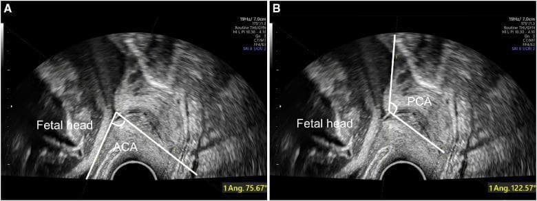 This diagnostic image consists of two sagittal-view transvaginal ultrasound (TVS) scans labeled A and B, illustrating the measurement of cervical angles in a late-pregnancy clinical setting. Both images show the fetal head in the cephalic presentation, the cervix, and the lower uterine segment. In Image A, the Anterior Cervical Angle (ACA) is measured at 75.67°, defined by the intersection of a line following the cervical canal and a line along the anterior uterine wall at the internal cervical os. In Image B, the Posterior Cervical Angle (PCA) is measured at 122.57°, formed by the intersection of the cervical canal line and a line extending along the posterior uterine wall. These ultrasound markers are utilized in obstetrics to assess the likelihood of successful spontaneous vaginal delivery (SVD) versus the risk of labor failure. The anatomical landmarks depicted facilitate the objective quantification of cervical-uterine geometry, where a wider angle generally indicates a more favorable alignment for fetal descent through the birth canal.