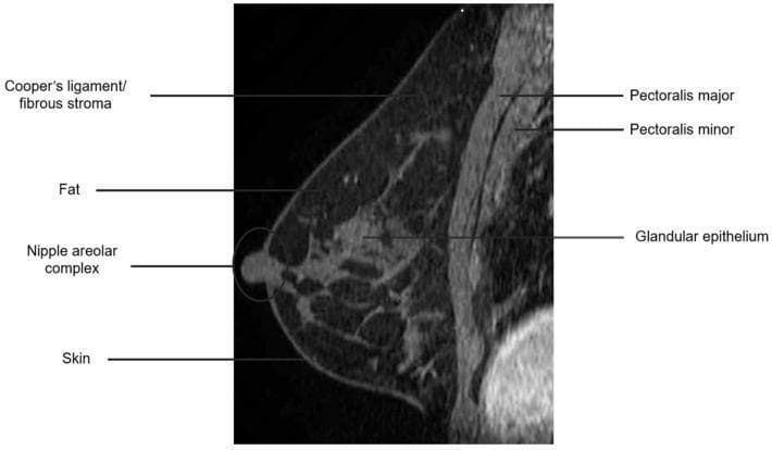This diagnostic image is a sagittal T1-weighted fat-suppressed post-contrast MRI of the human breast, demonstrating normal anatomical structures. The fat suppression technique renders adipose tissue (fat) dark (low signal intensity), while the glandular epithelium and vascularized structures show enhancement (high signal intensity) following contrast administration. Key anatomical landmarks are labeled: the pectoralis major and pectoralis minor muscles are located posteriorly (deep) to the breast parenchyma; the pectoralis major is positioned anterior to the pectoralis minor. Within the breast tissue, the glandular epithelium (fibroglandular tissue) is visible as high-signal regions, supported by the fibrous stroma or Cooper’s ligaments, which appear as thin connective bands extending toward the dermis. The skin and nipple-areolar complex are also labeled, defining the anterior boundary of the breast. This image serves as an educational reference for breast MRI anatomy and the visual impact of fat-suppression and contrast enhancement on different tissue types during oncological imaging.