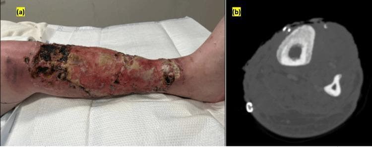 This composite educational figure illustrates the clinical and radiographic manifestations of chronic lower extremity infection. Panel (a) is a clinical photograph of a left lower leg demonstrating a extensive, circumferential ulcerated wound. The wound bed exhibits heterogenous tissue characteristics including dark black necrotic eschar, yellow-tan slough, and areas of reddish-pink granulation tissue with visible surgical staples from prior skin grafting. Significant circumferential erythema and swelling are present in the surrounding skin, consistent with cellulitis. Panel (b) is an axial contrast-enhanced CT scan of the same limb at the level of the mid-tibia and fibula. It reveals significant cortical thickening of the tibia, irregular bone erosions, and a periosteal reaction with new bone formation. Increased attenuation in the adjacent soft tissues suggests inflammation. Collectively, the images demonstrate a complex clinical scenario of chronic non-healing wounds complicated by secondary osteomyelitis, often seen in the context of intravenous drug use (IVDU) or severe skin and soft tissue infections (SSTIs).