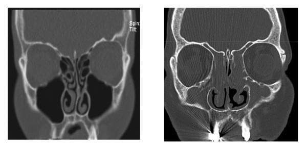 This diagnostic image displays a side-by-side comparison of two coronal CT scans of the paranasal sinuses. The left image represents a 'Normal' anatomy, characterized by clear, air-filled (black) maxillary and ethmoid sinuses, well-defined middle and inferior turbinates, and a patent osteomeatal complex. The nasal septum is midline and the nasal passages are open. In contrast, the right image depicts a patient with Chronic Rhinosinusitis with Nasal Polyps (CRSwNP). This scan reveals significant bilateral opacification of the ethmoid and maxillary sinuses, indicating mucosal thickening, fluid, or soft tissue masses. Large, irregular soft-tissue densities (nasal polyps) fill and obstruct the nasal cavities, obscuring the normal anatomy of the turbinates and significantly narrowing the airway passages. This comparison illustrates the typical radiographic presentation of sinonasal inflammatory disease and its impact on sinus aeration and nasal patency, commonly used in otolaryngology for diagnostic and surgical planning.