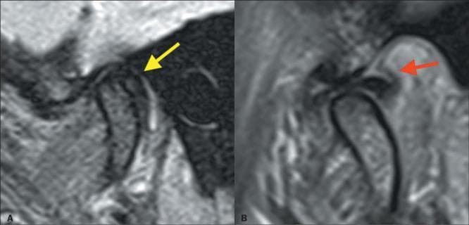 This Comparison Chart features side-by-side sagittal proton density (PD)-weighted MRI images of the temporomandibular joint (TMJ) in closed-mouth (A) and open-mouth (B) positions, illustrating internal derangement. Image A demonstrates rare posterior displacement of the biconcave articular disc (yellow arrow) relative to the mandibular condyle. Secondary signs include thickening of the posterior bilaminar zone (red arrow) and joint effusion, characterized by hyperintense signal within the joint space. Image B shows the dynamic progression where the disc is recaptured, returning to its physiological position between the condyle and the temporal bone's articular eminence as the jaw opens and the condyle translates anteriorly. The educational focus is on the diagnostic imaging features of disc displacement with reduction (recapture). This content is relevant for radiology and dentistry residents learning to interpret TMJ arthropathy, emphasizing the spatial relationship between the fibrocartilaginous disc and bony landmarks.