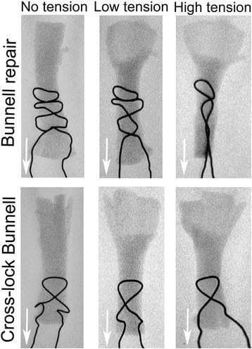 This orthopaedic diagnostic image consists of a series of six fluoroscopic panels demonstrating tendon repair biomechanics. The panels are organized into a 2x3 grid comparing two surgical suturing techniques—the Bunnell repair (top row) and the Cross-lock Bunnell (bottom row)—under three progressive load conditions: No tension, Low tension, and High tension. Radiopaque stainless steel wire is used to visualize the suture patterns within the tendon segments. In the Bunnell repair, increasing tension causes the distinct, loosely arranged loops to constrict and 'cut out' through the soft tissue, leading to significant longitudinal elongation and narrowing of the suture configuration. In contrast, the Cross-lock Bunnell row demonstrates a more stable, interwoven interlocking pattern. As tension increases in the Cross-lock group, the suture maintains better structural integrity and consistent apposition with minimal 'cut out' or longitudinal distortion compared to the standard Bunnell technique. White arrows indicate the direction of the applied axial load, illustrating the mechanical failure mechanism and resistance to gap formation in tendon surgery.
