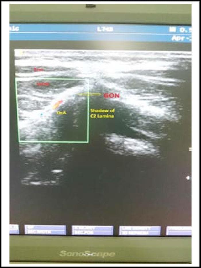 A diagnostic ultrasound image of the posterior neck region, utilized for guiding a greater occipital nerve (GON) block. The image displays the musculoskeletal and vascular anatomy at the level of the upper cervical spine. Visible layers include the trapezius muscle (TrM) and the semispinalis capitis muscle (SsCM), characterized by their striated, heterogeneous echotexture. The greater occipital nerve (GON) is identified as a small, oval structure located medial to the occipital artery (OcA), which appears as a circular hypoechoic or anechoic vascular structure. Deep to these soft tissue layers, a prominent hyperechoic bony surface with an associated posterior acoustic shadow represents the C2 lamina. This imaging modality and view are clinically significant for the precise localization of the nerve in the management of post-dural puncture headache (PDPH) or occipital neuralgia, ensuring accurate anesthetic deposition while avoiding vascular puncture.