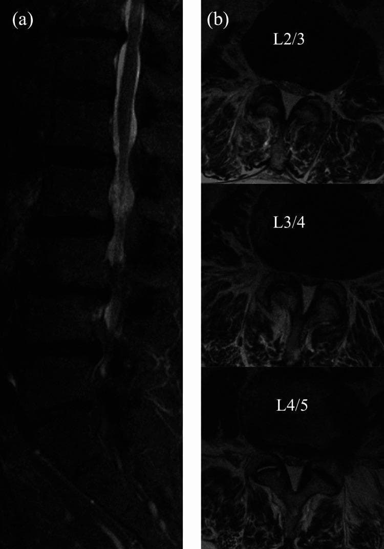 Diagnostic Image: Magnetic Resonance Imaging (MRI) of the lumbar spine. (a) Sagittal plane MRI showing the longitudinal thecal sac. There is evidence of multi-level spinal canal narrowing, particularly notable for areas of relative expansion and hyperintensity in the CSF space between segments of narrowing, indicating multilevel stenosis. (b) Axial plane MRI slices at L2/3, L3/4, and L4/5 levels. At L2/3 and L3/4, the spinal canal appears constricted with heterogeneous signal intensity, suggesting compression of the cauda equina. At the L4/5 level, a distinct 'Y-shaped' hyperintense configuration is visible within the canal, characteristic of dural foldings or anatomical variations associated with high-grade stenosis or post-operative changes. This imaging is clinically relevant for evaluating lumbar spinal stenosis and the risk factors for postoperative spinal epidural hematoma (POSEH). It demonstrates structural changes in the dural sac morphology across different vertebral levels, serving as an educational resource for orthopedic surgeons and radiologists in assessing spinal canal patency.