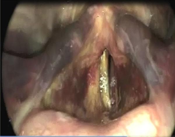 This clinical photograph displays an endoscopic view (videolaryngoscopy) of the larynx, highlighting significant laryngeal trauma. The image demonstrates a widespread laryngeal hematoma, characterized by prominent purplish-red and ecchymotic discoloration across the laryngeal mucosa. Marked edema and swelling are visible throughout the supraglottic and glottic regions, leading to structural distortion and partial obscuration of the true vocal folds. The rima glottidis is significantly narrowed and compromised by the surrounding inflammatory changes and blood accumulation. There is also evidence of superficial fibrin or discharge on the vocal fold surfaces. This visual serves as a critical example of postoperative or post-intubation laryngeal complications, illustrating the physical manifestations of airway trauma that may lead to vocal symptoms like hoarseness or respiratory distress in an otolaryngology context.