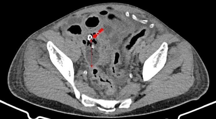 This diagnostic image is an axial computed tomography (CT) scan of the lower abdomen and pelvis. The image demonstrates a complex inflammatory process in the right lower quadrant. A solid red arrow points to a calcified hyperdense structure, consistent with an appendicolith, which is acting as the source of obstruction. Adjacent to this, a thin double-headed red arrow delineates a thick, irregular fluid collection and soft tissue stranding indicative of an abscess formation and localized peritonitis. There is associated fat stranding and thickening of the surrounding bowel loops, suggestive of secondary small intestinal obstruction or ileus. These radiological findings are highly characteristic of complicated, perforated appendicitis. The scan provides critical evidence for surgical consultation in the context of acute abdominal pain and suspected intra-abdominal pathology.