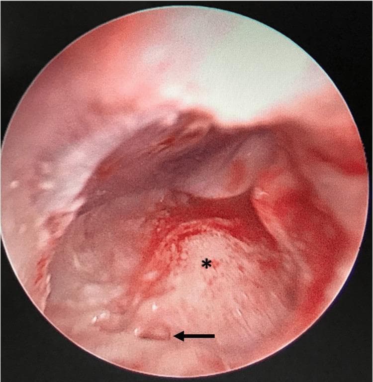 This clinical image presents an intraoperative endoscopic view of the human middle ear, obtained via a posterior tympanotomy. The field of view reveals the anatomical landmarks critical for otologic surgery, specifically cochlear implantation. A prominent, rounded, pinkish-white structure marked with an asterisk (*) represents the promontory, which corresponds to the basal turn of the cochlea. The surrounding mucosal tissue is erythematous and vascularized. A black horizontal arrow points to a localized region of bone covering the expected location of the round window niche, identifying an atretic round window plate. This finding is of high clinical significance as it indicates a congenital anomaly that complicates surgical access to the scala tympani. The image demonstrates the utility of otoendoscopy in identifying subtle middle ear pathologies that may be difficult to visualize using a standard operating microscope during mastoidectomy.