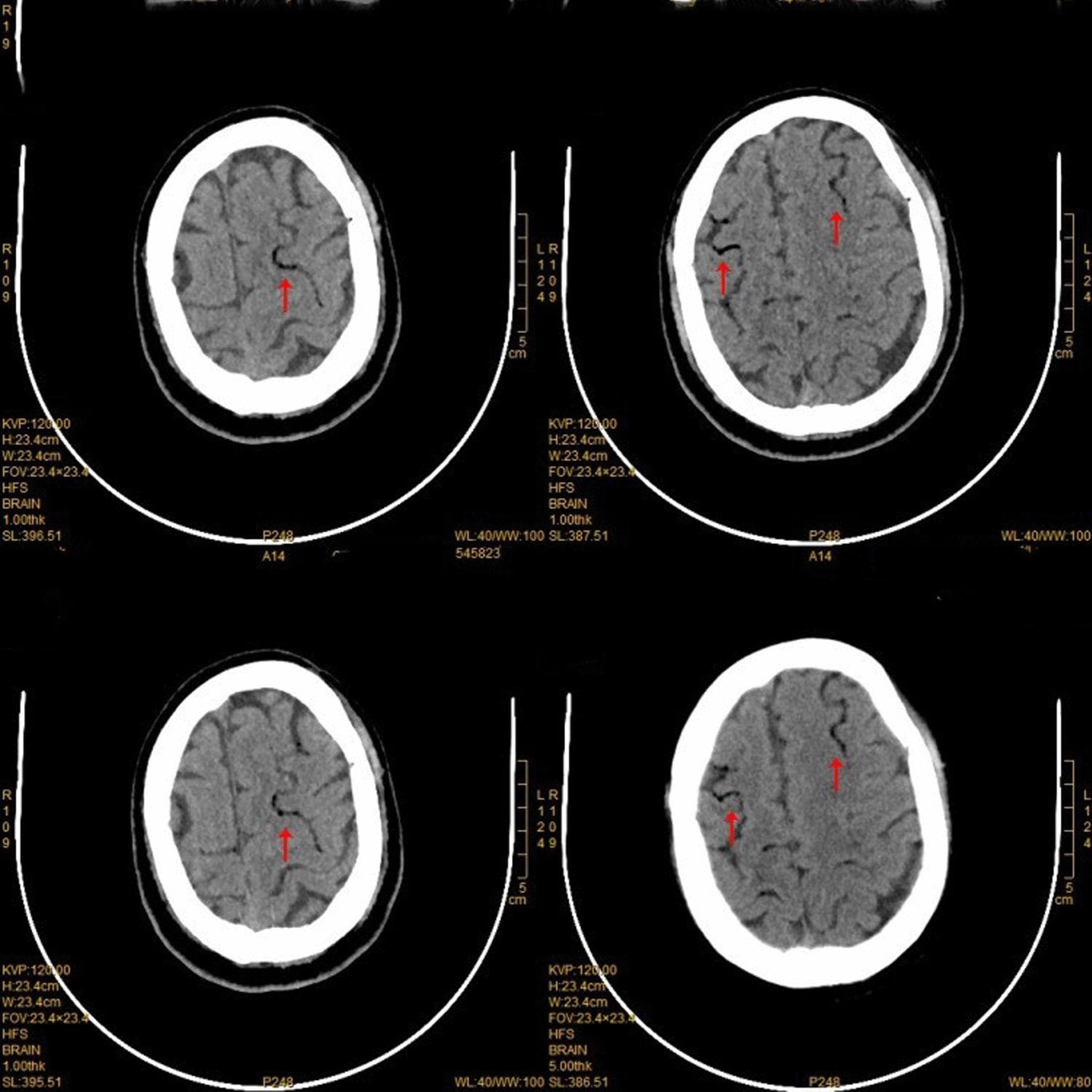 This diagnostic image consists of four non-contrast axial CT scan slices of the human brain, focusing on the superior frontal regions. The primary pathological finding is the presence of multiple, well-defined areas of abnormal lucency (low density) within the cortical blood vessels. These lucent pockets, marked by red arrows, follow the serpentine course of the sulci in the bilateral frontal lobes, appearing as dark, air-density streaks and bubbles contrasting sharply against the higher density of the blood and adjacent brain parenchyma. The distribution is predominantly cortical and peripheral. Clinically, these findings are pathognomonic for cerebral air embolism, demonstrating gas trapped within the distal cerebral vasculature. The image illustrates the disruption of normal anatomical density in a clinical emergency scenario, often occurring as a complication of thoracic procedures or trauma. The scans are useful for teaching the radiological identification of intravascular air and the diagnosis of iatrogenic or traumatic cerebral air embolism.