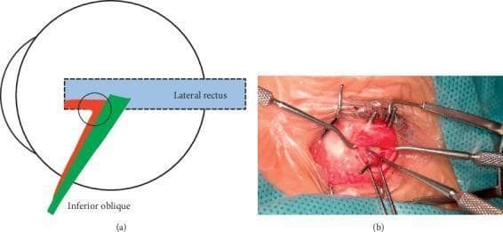 This composite educational material consists of an anatomical diagram and a clinical photograph detailing Type-beta inferior oblique muscle enlargement (IO-E). Part (a) is a schematic illustration of the lateral aspect of the eye globe. It depicts the lateral rectus muscle (blue) and the inferior oblique muscle bifurcating into two bundles: a posterior bundle (green) that inserts into the conventional scleral position, and an anterior bundle (red) that loosely connects at the conventional insertion (purple circle) before coursing anteriorly beneath the lateral rectus to fuse with its insertion point. Part (b) is an intraoperative clinical photograph providing a surgical view of the ocular surface during strabismus surgery. The white sclera is exposed, and various surgical instruments, including muscle hooks, forceps, and a lid speculum, are used to manipulate the extraocular tissues and muscles for visualization of anomalous attachments. This content is intended for ophthalmic specialty training, focusing on surgical anatomy and the diagnosis of extraocular muscle variations related to vertical strabismus and V-pattern exotropia.