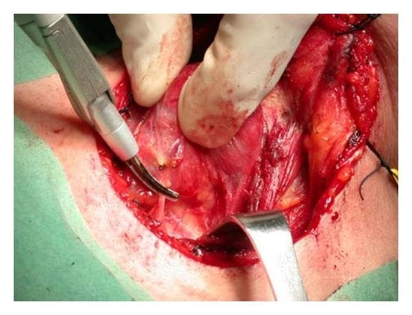 A close-up clinical photograph showing an intraoperative view of a total thyroidectomy. The surgical site displays exposed deep neck tissues, including the thyroid lobe being medially rotated by a surgeon's gloved hand. A Focus Ultracision Harmonic Scalpel, characterized by its metallic body and curved active blade tip, is positioned to seal and divide the inferior thyroid artery. The surgical field exhibits characteristic features of active dissection: red vascularized tissue, fibrous bands, and some peripheral bruising at the skin incision edges. A metal retractor is visible at the bottom of the frame, maintaining exposure of the operative field, while black silk sutures are noted at the superior aspect for tissue traction or marking. This image demonstrates the application of ultrasonic energy for simultaneous cutting and coagulation (hemostasis) in head and neck surgery, specifically targeting significant vascular structures like the thyroid arteries to minimize blood loss and operative time.
