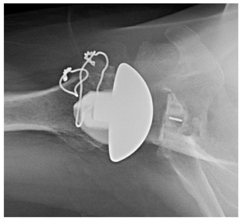 This axillary view X-ray of the shoulder demonstrates a total shoulder arthroplasty featuring an inlay glenoid polyethylene component, specifically indicated for glenoid dysplasia. The humeral head has been replaced with a hemispherical prosthetic component. Adjacent to the prosthetic humeral head, cerclage wires or surgical suture wires are visible, secured to the proximal humerus with small radiopaque anchors, likely to reinforce a tuberosity osteotomy or soft tissue repair. The glenoid side shows a polyethylene inlay component seated within the native glenoid fossa. A small, horizontal radiopaque marker pin is visible within the glenoid component to facilitate radiographic assessment of its position and orientation. The joint space between the humeral prosthetic head and the glenoid surface is clearly maintained. This imaging is characteristic of orthopedic surgery for complex glenoid anatomy, highlighting the specialized use of inlay components to manage bone deficiency or dysplasia in shoulder reconstruction.