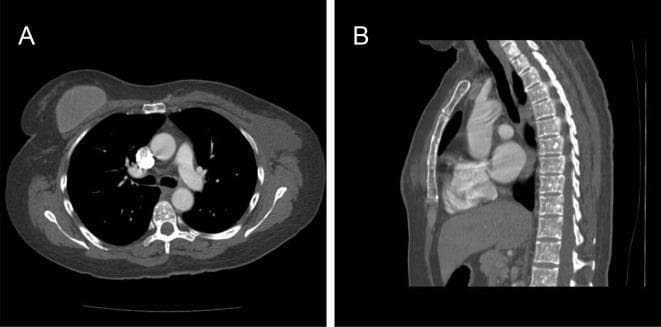 This diagnostic image consists of two Computed Tomography (CT) scans of the thorax in axial (A) and sagittal (B) planes, demonstrating diffuse skeletal findings. Image A, an axial section at the level of the T7 vertebra, reveals multiple, small, well-circumscribed, rounded sclerotic foci (osteosclerotic lesions) within the vertebral body. Image B, a sagittal reconstruction, highlights the extensive distribution of these high-density sclerotic nodules throughout the thoracic vertebral bodies and the sternum. The lesions are uniform in density and lack associated soft tissue masses or cortical destruction. In an oncology context, such as breast cancer, these findings necessitate differentiation between osteoblastic metastases and benign skeletal dysplasias like osteopoikilosis. The image illustrates a key diagnostic challenge in radiology: distinguishing widespread benign sclerotic bone islands from metastatic disease. Visible anatomical landmarks include the cardiac chambers, pulmonary trunk, descending aorta, and the thoracic spinal column.