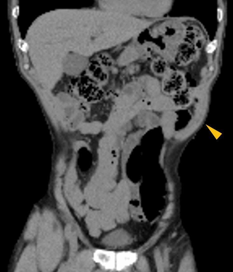 A diagnostic image showing a coronal view of a non-contrast abdominal CT scan. The image displays the anatomy of the torso, including the liver in the right upper quadrant, the spleen in the left upper quadrant, and loops of the small and large intestines containing gas and fecal material. A yellow arrowhead points to a focal area of the left lateral abdominal wall where there is a distinct outward bulging. This area is characterized by thinning and relaxation of the abdominal wall musculature (oblique and transversus abdominis muscles). Notably, there is no evidence of a fascial defect, hernia sac, or protrusion of intra-abdominal contents into the bulge, a finding characteristic of an abdominal pseudohernia. This clinical entity is often associated with neuropathic muscle paralysis, such as that caused by herpes zoster reactivation or post-surgical nerve injury. The image serves as a clinical reference for differentiating pseudohernia from true incisional or ventral hernias based on the preservation of anatomical continuity despite muscle laxity.
