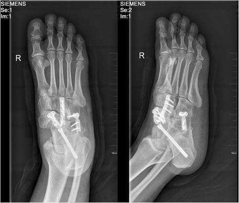 This diagnostic image consists of two postoperative radiographs (anteroposterior and lateral oblique views) of the right foot following a triple arthrodesis procedure, frequently used for managing advanced Mueller-Weiss disease. The images demonstrate extensive metallic internal fixation hardware. A long compression screw is seen traversing from the posterior calcaneus through the subtalar joint into the talar body. Additionally, a combination of orthopedic plates and screws is utilized to stabilize the talonavicular and calcaneocuboid joints, creating a rigid fusion across the hindfoot and midfoot. Another plate and screw construct appears to bridge the naviculocuneiform joint space. The radiograph shows evidence of bone grafting at the site of the navicular, which typically exhibits loss of volume and increased radiodensity in Mueller-Weiss disease. The primary educational focus is the visual demonstration of surgical stabilization and joint fusion (arthrodesis) techniques used to correct midfoot deformity and address chronic pain associated with idiopathic tarsal navicular osteonecrosis.