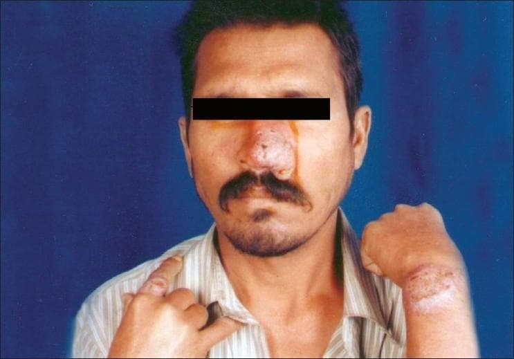 Content Type: Clinical Photograph. This image displays multiple skin lesions on a 45-year-old male. The primary visual finding is a large, infiltrated, nodular plaque covering the majority of the nasal bridge and tip, appearing raised with areas of surface irregularity and mild serosanguinous discharge. Secondary lesions include a well-demarcated, hypopigmented, and scaly plaque on the dorsum of the left wrist and a similar infiltrated nodule on the right index finger. Medical Context: These clinical manifestations are consistent with Post-Kala-azar Dermal Leishmaniasis (PKDL) in an HIV-positive patient, characterized by disseminated nodules and plaques containing Leishman-Donovan bodies. Educational Significance: The photograph illustrates the atypical and more aggressive presentation of cutaneous leishmaniasis in immunocompromised individuals. Target Audience: Dermatologists, infectious disease specialists, and medical students. Keywords: Infiltrated plaque, nodular lesion, hypopigmentation, nasal lesion, cutaneous leishmaniasis, HIV-coinfection, tropical medicine.