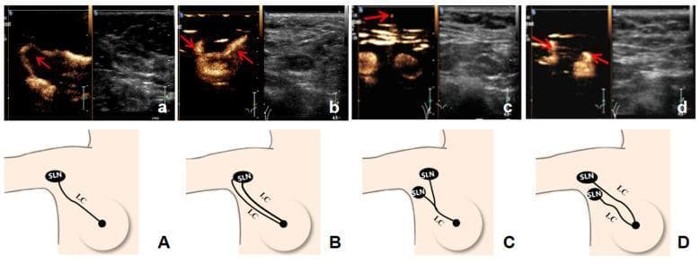 This composite educational graphic illustrates four distinct patterns of axillary lymphatic drainage from the breast to sentinel lymph nodes (SLNs), using Contrast-Enhanced Ultrasound (CEUS) imaging and corresponding anatomical diagrams. The visual material is divided into four sets (A–D), each featuring a split-screen ultrasound image (CEUS and B-mode) alongside a schematic illustration. The primary components described are Lymphatic Channels (LC) and Sentinel Lymph Nodes (SLN). The four patterns shown are: (A) a single LC draining to a single SLN; (B) multiple LCs converging into a single SLN; (C) a single LC branching to multiple SLNs; and (D) multiple LCs draining to multiple separate SLNs. In the CEUS images, the LCs and SLNs are identified by high echogenicity (bright contrast enhancement) indicated by red arrows, facilitating real-time visualization of the drainage pathway. This content is intended for surgical oncology and radiology education, specifically regarding preoperative sentinel lymph node biopsy (SLNB) mapping in breast cancer staging. It demonstrates how CEUS can be used to identify complex lymphatic anatomy that may impact surgical planning.