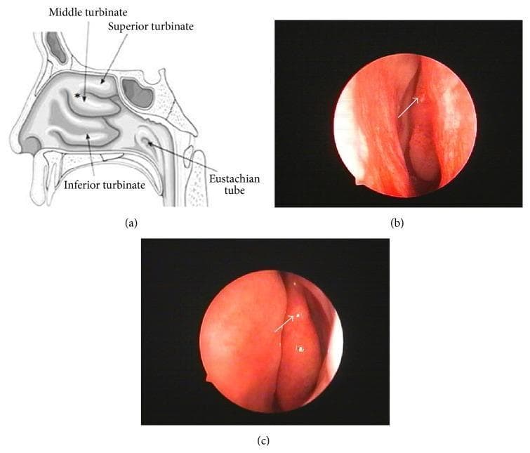 This figure provides a comprehensive overview of the right nasal cavity's internal anatomy through a schematic diagram and endoscopic photographs. Image (a) is an anatomical diagram in the sagittal plane, labeling the superior, middle, and inferior turbinates, and the opening of the Eustachian tube. An asterisk identifies the root of the middle turbinate as a site for biopsy. Images (b) and (c) are clinical endoscopic photographs (rhinoscopy) showing the internal mucosal environment. The mucosa appears healthy, erythematous, and moist. Image (b) shows the endoscopic view during the tissue sampling process, with an arrow indicating the middle turbinate. Image (c) shows the same anatomical site one month post-biopsy, demonstrating successful tissue healing and mucosal regeneration at the donor site. These visuals illustrate the clinical approach to obtaining olfactory mucosa samples for research or stem cell isolation while highlighting the anatomical landmarks and the subsequent healing process in otolaryngology.