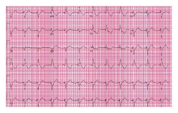 A standard 12-lead electrocardiogram (ECG) printed on red grid paper demonstrating a ventricular paced rhythm with a right bundle branch block (RBBB) morphology. Each cardiac cycle is preceded by a distinct vertical pacemaker spike immediately before the QRS complex. The QRS complexes are significantly widened (prolonged duration) across all leads. In the right precordial lead (V1), a prominent 'rsR' pattern or notched R-wave is visible, characteristic of RBBB. The lateral leads (I, aVL, V5, V6) show broad, slurred S-waves. The rhythm is irregularly irregular, consistent with underlying atrial fibrillation. The T-waves demonstrate secondary repolarization changes, appearing inverted or discordant with the primary QRS deflection in several leads. This tracing is clinically significant for demonstrating an atypical pacing pattern; while right ventricular pacing typically produces a left bundle branch block (LBBB) morphology, the RBBB pattern shown here may indicate lead malposition into the left ventricle or an interventricular septal defect.
