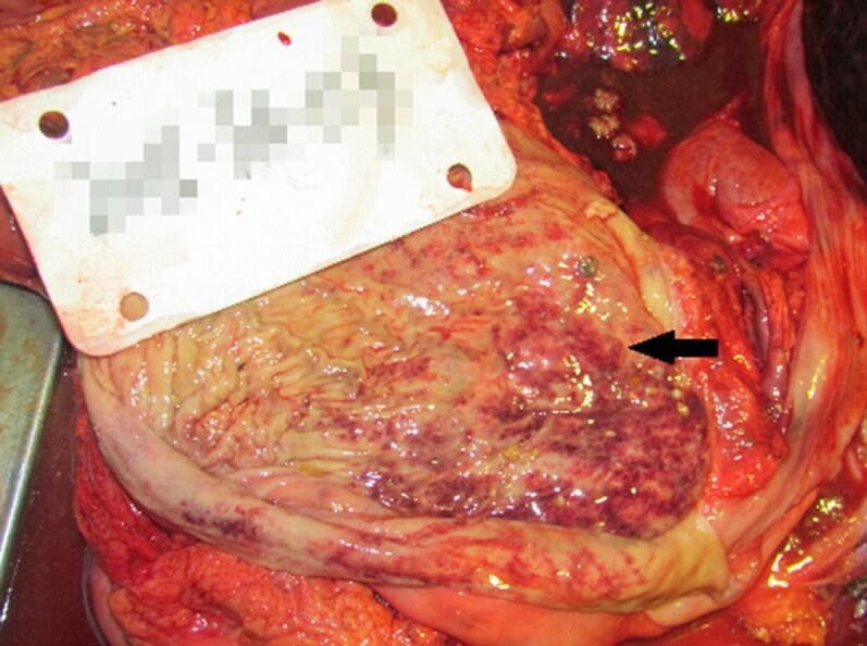 This clinical gross specimen photograph displays the internal surface of a human stomach during an autopsy. The gastric mucosa shows clear signs of pathology characterized by light, focal haemorrhage. The mucosal surface exhibits an uneven, mottled appearance with scattered petechiae and larger areas of ecchymosis, particularly prominent in the region indicated by the black arrow. These haemorrhagic foci appear as dark red to purple discolorations interspersed with the paler, tan-pink tissue of the normal gastric folds (rugae). The irregular distribution of these spots suggests acute mucosal injury or congestion. Such findings in a forensic or clinical pathology context can be associated with various systemic stressors, including acute alcohol poisoning or severe physiological shock. The image serves as a teaching tool for identifying macroscopic signs of gastric mucosal haemorrhage and inflammation during post-mortem examination.