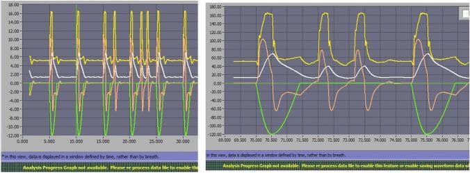 This diagnostic graphic displays mechanical ventilation waveforms from a Hamilton C3 ventilator during Pressure Support Ventilation (PSV 10), illustrating ventilator asynchrony under restrictive lung patterns with air leaks. Two side-by-side time-series graphs plot respiratory parameters: Airway Pressure (Paw, yellow), Delivered Volume (white), Flow (red/orange), and Muscular Pressure (green). The green line represents patient effort (negative deflection indicates inspiration), while the yellow and white lines represent ventilator response. The image specifically highlights 'Auto-triggering' (AT), a form of patient-ventilator asynchrony where the ventilator delivers a breath without an antecedent drop in muscular pressure. This is evident where peaks in airway pressure (yellow) and flow (red/orange) occur in the absence of a corresponding green negative deflection. The graph on the right provides a high-resolution view of these cycles, demonstrating the synchronization failure between the patient's intrinsic respiratory drive and the ventilator's trigger sensitivity (set at 1 lpm). This material is intended for advanced clinical education regarding mechanical ventilation monitoring and the identification of asynchronies in restrictive respiratory conditions.