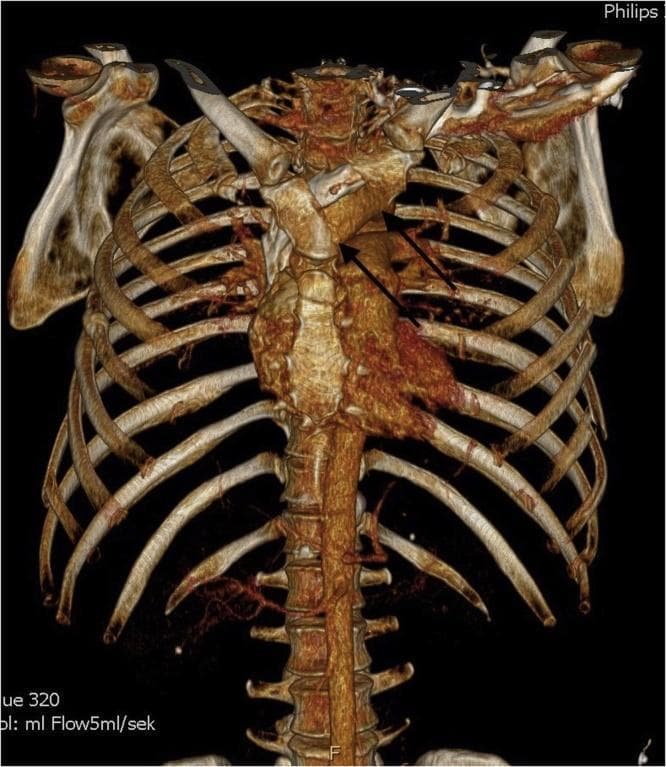 This diagnostic image is a 3D Volume Rendering Technique (VRT) reconstruction of a thoracic CT scan, showing the anterior ribcage, sternum, and thoracic spine of a trauma patient. The visual highlights a clinical flail chest injury. Multiple rib fractures are evident on the left side of the ribcage, specifically manifesting as lateral costal fractures and an anterior fracture line. The sternum is also compromised; two black arrows point to a transverse fracture through the manubrium. The 3D reconstruction provides a clear spatial orientation of the skeletal instability, demonstrating the disrupted integrity of the chest wall. Key anatomical landmarks include the clavicles, manubrium, body of the sternum, ribs, and vertebral column. This image is used for educational purposes to demonstrate complex thoracic trauma, surgical planning for rib fixation, and the radiological appearance of unstable chest wall injuries in a clinical emergency context.