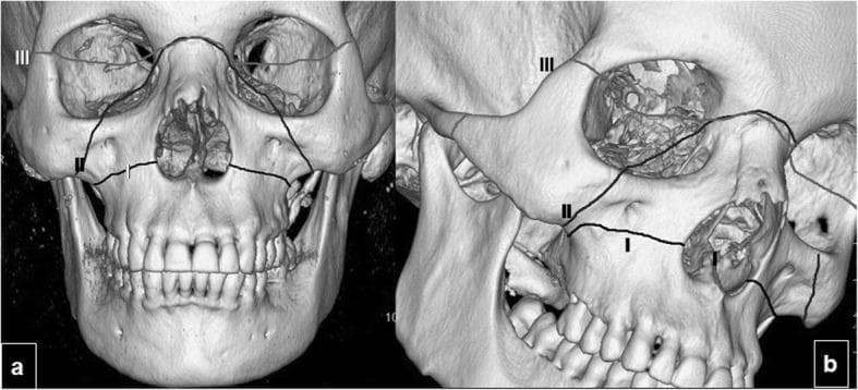 Educational 3D CT reconstruction of an adult human skull demonstrating the classic classification of midface fractures. The image consists of two panels: (a) a frontal (anterior) view and (b) an oblique view, both featuring overlaid black lines representing the three types of Le Fort fractures.
- Le Fort I: Indicated by a horizontal fracture line passing through the maxilla, superior to the alveolar process and maxillary teeth, effectively separating the palate from the rest of the face.
- Le Fort II: Depicted as a pyramidal fracture line extending from the lateral maxilla, through the infraorbital rims and nasal bones, involving the midfacial structures.
- Le Fort III: Labeled at the superior aspect, showing complete craniofacial disjunction where the fracture line traverses the zygomatic arches, the lateral orbital walls, and the nasofrontal suture, separating the facial skeleton from the cranial base.
The visualization serves as a diagnostic algorithm for maxillofacial trauma, highlighting the anatomical involvement of the orbits, nasal cavity, and zygomaticomaxillary complex.
