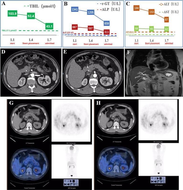 A multi-panel figure illustrating diagnostic findings and clinical progression for a biliary obstruction and pancreatitis case. (A-C) Line graphs track liver function tests, showing a downward trend in total bilirubin (TBIL), gamma-glutamyl transpeptidase (γ-GT), alkaline phosphatase (ALP), alanine aminotransferase (ALT), and aspartate aminotransferase (AST) from initial presentation through biliary stent placement to admission. (D, E) Axial contrast-enhanced CT scans of the abdomen show a hyperdense biliary stent within the common bile duct, accompanied by a plump pancreatic parenchyma and peripancreatic fat stranding (cloudy adipose tissue) indicative of secondary pancreatitis. (F) Coronal Magnetic Resonance Cholangiopancreatography (MRCP) reveals the biliary anatomy and site of ductal stenosis. (G, H) PET-CT transaxial, PET, and fused images demonstrate the metabolic activity in the upper abdomen, used here to screen for malignancy. This composite clinical visual serves as an educational tool for integrating biochemical trends with multimodality imaging (CT, MRCP, PET-CT) in the workup of hepatobiliary diseases and pancreatic complications.