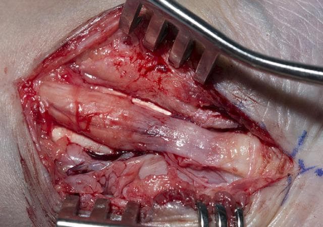 This clinical photograph captures an intraoperative view of a carpal tunnel decompression surgery, focusing on the median nerve. The image illustrates classic pathological changes associated with chronic nerve compression: a proximal bulbous swelling (pseudoneuroma) of the nerve followed by significant distal thinning (hourglass deformity) beneath the site of the flexor retinaculum. The median nerve appears pale and glistening, while the surrounding surgical field shows signs of inflammation, hemorrhage, and extensive fibrosis. Retractors are positioned to expose the nerve and underlying flexor tendons, which appear infiltrated by scar tissue and thickened subsynovial connective tissue. This visual serves as an educational example of severe carpal tunnel syndrome and the anatomical landmarks encountered during surgical release, including the relationship between the nerve, tendons, and surrounding fibrotic changes.