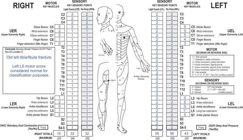 This infographic presents a standardized International Standards for Neurological Classification of Spinal Cord Injury (ISNCSCI) worksheet, also known as the ASIA (American Spinal Injury Association) chart. The diagram illustrates a neurological examination of a patient with a spinal cord injury (SCI) and a superimposed non-SCI condition (old left tibia/fibula fracture). It displays motor and sensory scores for the right and left sides across C2 to S4-5 segments. Sensory evaluation includes light touch and pin prick scores, while motor evaluation covers key muscle groups in the upper (C5-T1) and lower (L2-S1) extremities. A central anatomical diagram maps dermatomes and key sensory points. Specific findings highlight a motor score of 1* for the left L5 (long toe extensor), with a comment box indicating this should be treated as normal for classification due to the peripheral injury. The worksheet includes binary assessments for Voluntary Anal Contraction (VAC) and Deep Anal Pressure (DAP), as well as calculated total scores for motor and sensory function, serving as a critical diagnostic tool for determining the Neurological Level of Injury (NLI) and ASIA Impairment Scale (AIS) grade.