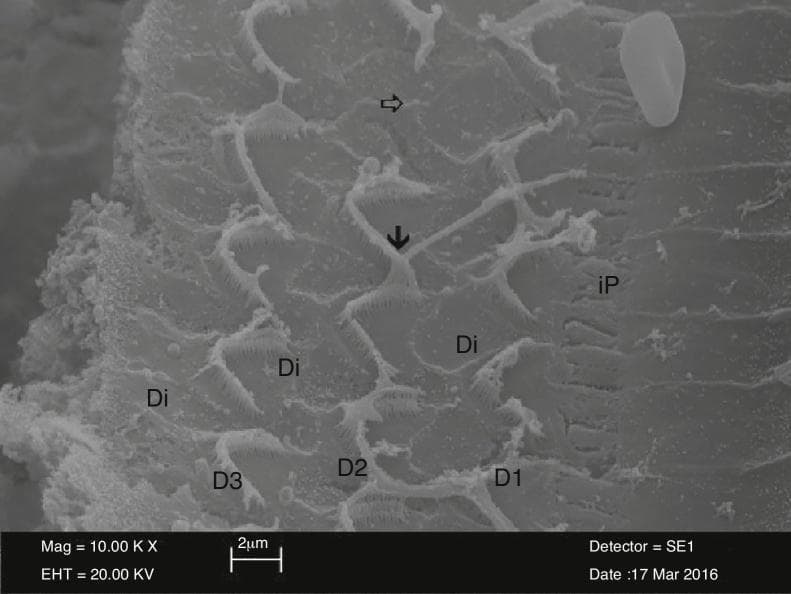 Scanning electron microscopy (SEM) image at 10,000x magnification showing the surface morphology of the Organ of Corti. The micrograph displays three rows of outer hair cells (labeled D1, D2, and D3) interspersed with supporting Deiters cells (Di) and adjacent to an inner pillar cell (iP). While the characteristic 'W' or 'V' shape arrangement of the stereocilia bundles is partially preserved, significant pathological changes are visible. A solid black arrow identifies apical adhesions where individual stereocilia have fused, making them indistinguishable from one another. A hollow white arrow indicates an area of outer hair cell loss and stereocilia degradation, representing structural irregularities in the sensory epithelium. This diagnostic image illustrates cellular-level ototoxicity or mechanical damage to the cochlear structures, focusing on the relationship between sensory hair cells and the reticular lamina formed by supporting cells.