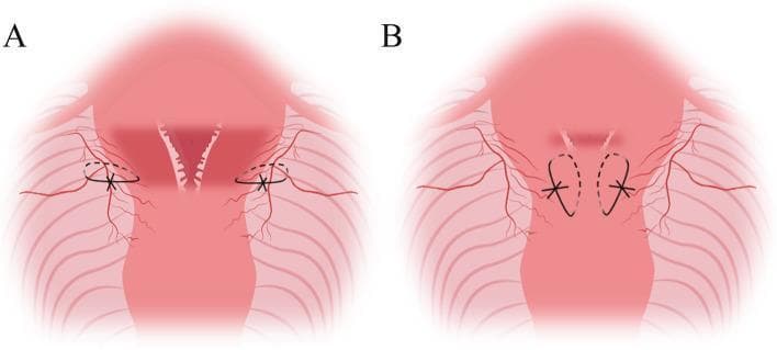 A schematic medical illustration depicting two stages of 'King’s combined uterine suture,' a surgical technique used for managing postpartum hemorrhage. The diagram uses shades of red to represent the uterus, cervix, and surrounding pelvic vasculature. Figure A illustrates parauterine vascular ligation, showing black sutures encircling the uterine artery and lateral vessels at the level of the lower uterine segment/cervical junction. Figure B demonstrates the longitudinal suture of the lower uterine segment, where the sutures are placed in a vertical 'U' configuration through the anterior and posterior uterine walls. Dashed lines indicate the internal path of the needle through the myometrium, while solid lines and 'X' symbols represent the external visible thread and knots. This illustration serves as a pedagogical guide for obstetricians and surgeons to visualize needle placement and suture geometry during uterine compression procedures, specifically aimed at devascularization and mechanical compression of the lower uterine segment.