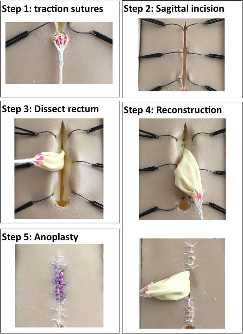This surgical simulation infographic details the sequential steps of a Posterior Sagittal Anorectoplasty (PSARP) for Anorectal Malformation (ARM) using a synthetic training model. The procedure is shown in five distinct intraoperative stages. Step 1 (Traction Sutures) demonstrates the placement of silk and colored sutures at the ectopic anal site to provide orientation and traction. Step 2 (Sagittal Incision) shows a vertical midline perineal incision with the skin edges retracted by stay sutures to expose deep tissues. Step 3 (Dissect Rectum) depicts the mobilization of the rectum, represented by a beige balloon-like structure, through the sagittal opening. Step 4 (Reconstruction) shows the anatomical repositioning and tapering of the rectum within the muscle complex. Step 5 (Anoplasty) illustrates the final closure, where the rectum is sutured to the skin to create a new anal opening, featuring visible blue and white interrupted sutures. The series serves as an educational tool for pediatric surgical trainees to visualize surgical landmarks, tissue manipulation, and suture techniques required for repairing anorectal defects.