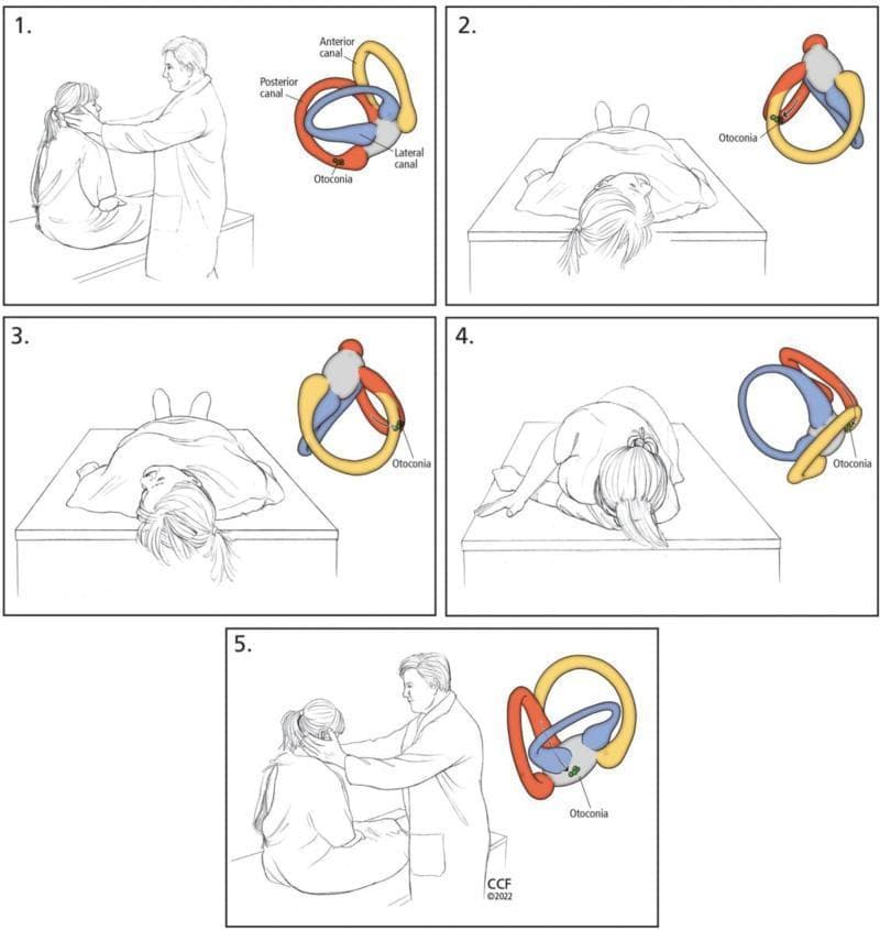 A five-panel medical illustration sequence detailing the Epley maneuver for treating Benign Paroxysmal Positional Vertigo (BPPV). Each panel pairs a clinical illustration of a patient and clinician with a corresponding anatomical diagram of the right inner ear's semicircular canals (anterior in yellow, posterior in red, and lateral in blue). Step 1 shows the patient seated with the head rotated 45° toward the affected side, with otoconia located in the posterior canal. Step 2 depicts the patient moved into a supine position with the neck slightly extended. Step 3 illustrates the head being rotated 90° toward the opposite (healthy) side. Step 4 shows the patient rolling onto their side while maintaining head rotation, facilitating the movement of otoconia through the canal toward the utricle. Step 5 shows the patient returning to a seated position. The anatomical insets track the gravitational migration of otoconia out of the posterior semicircular canal, demonstrating the mechanical rationale for this canalith repositioning procedure.