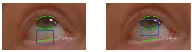 This clinical image consists of two side-by-side close-up photographs of a human eye, demonstrating computer vision and machine learning techniques for ophthalmologic assessment. The images utilize annotated overlays to track key anatomical landmarks related to Myasthenia Gravis (MG) evaluation, specifically for ptosis (eyelid droop). Red dots represent machine learning-derived landmarks at the eye corners and lid margins. Green curved lines delineate the upper eyelid contour, the lower eyelid margin, and the limbus (the interface between the iris and sclera). Blue bounding boxes define 'Regions of Interest' (ROI); in the left frame, the box targets the lower eyelid-sclera junction, while in the right frame, it frames the inferior iris-sclera boundary. This methodology is designed for automated, quantitative monitoring of eyelid distance and eye area during sustained upward gaze, providing objective data for telemedicine-based clinical examinations of neuromuscular junction disorders.